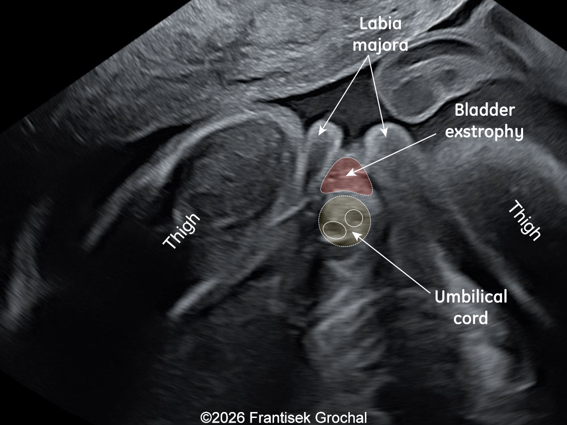 The image demonstrates a caudal tangential view of the female fetus affected by bladder exstrophy.