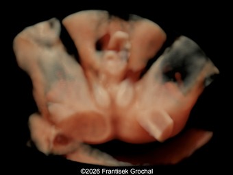 Case of the Week # XXX Bladder extrophy
